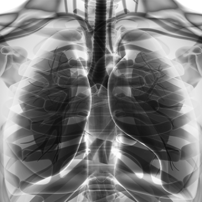 Global burden of lower respiratory infections and aetiologies, 1990–2023: a systematic analysis for the Global Burden of Disease Study 2023
